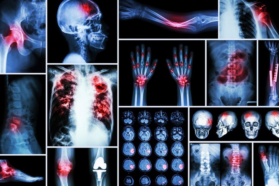 Bone Cancer Treatment by TheTole