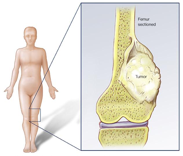 Bone Cancer Cure in KL Malaysia